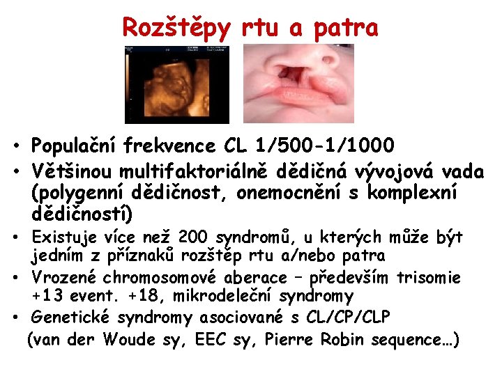 Rozštěpy rtu a patra • Populační frekvence CL 1/500 -1/1000 • Většinou multifaktoriálně dědičná