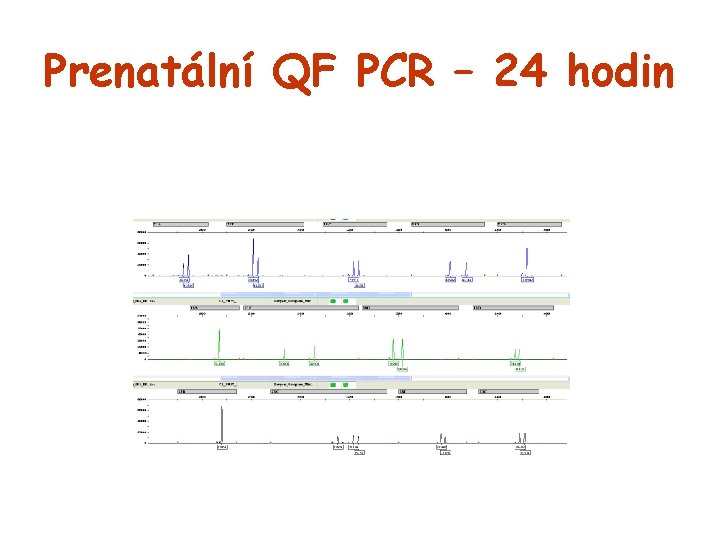 Prenatální QF PCR – 24 hodin 