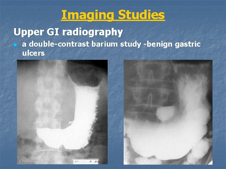 Imaging Studies Upper GI radiography n a double-contrast barium study -benign gastric ulcers 