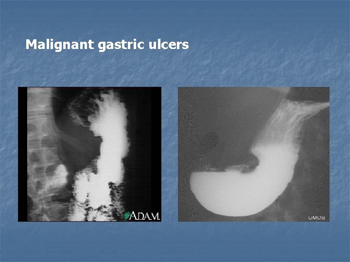 Malignant gastric ulcers 