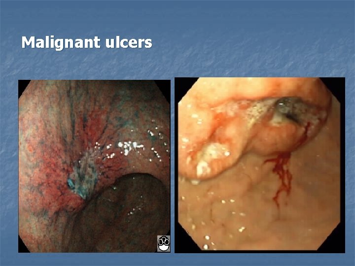 Malignant ulcers 