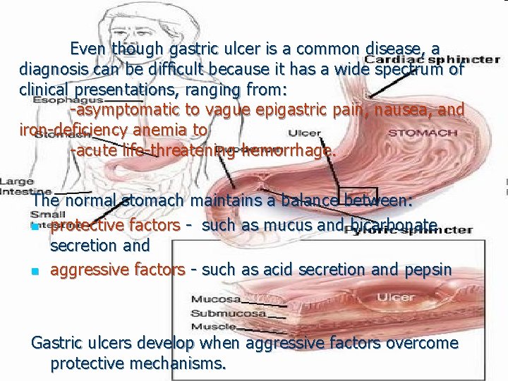 Even though gastric ulcer is a common disease, a diagnosis can be difficult because
