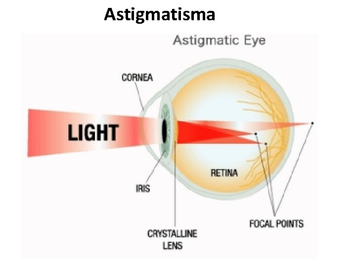 Astigmatisma 