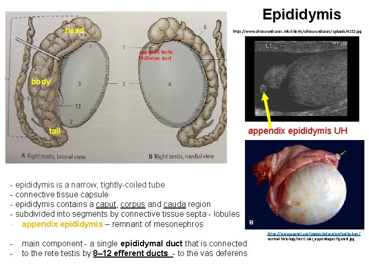 Epididymis head https: //www. ultrasoundcases. info/clients/ultrasoundcases/uploads/4222. jpg appendix testis Müllerian duct body tail appendix