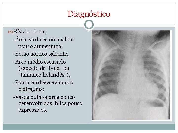 Diagnóstico RX de tórax: -Área cardíaca normal ou pouco aumentada; -Botão aórtico saliente; -Arco