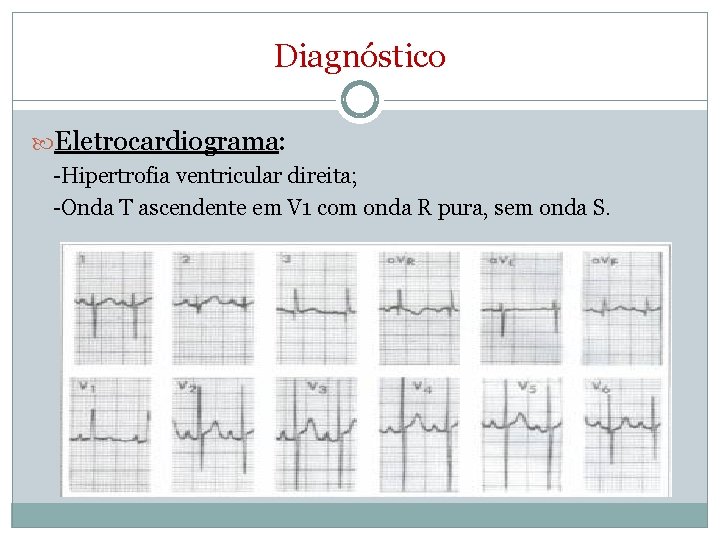 Diagnóstico Eletrocardiograma: -Hipertrofia ventricular direita; -Onda T ascendente em V 1 com onda R