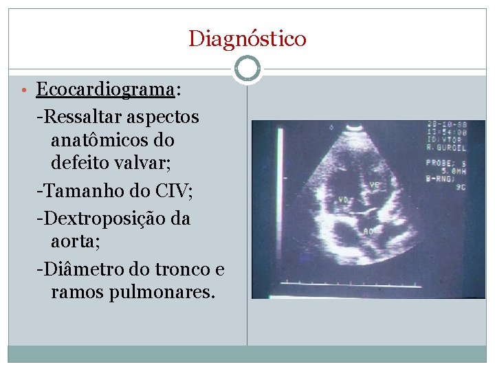 Diagnóstico • Ecocardiograma: -Ressaltar aspectos anatômicos do defeito valvar; -Tamanho do CIV; -Dextroposição da