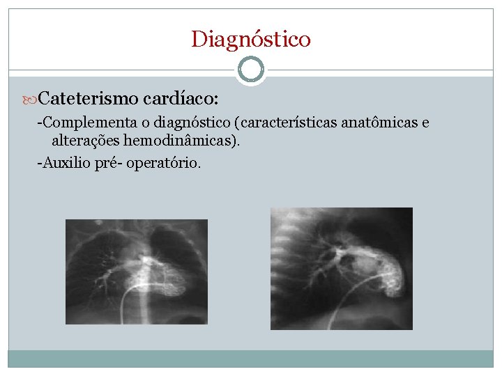 Diagnóstico Cateterismo cardíaco: -Complementa o diagnóstico (características anatômicas e alterações hemodinâmicas). -Auxilio pré- operatório.