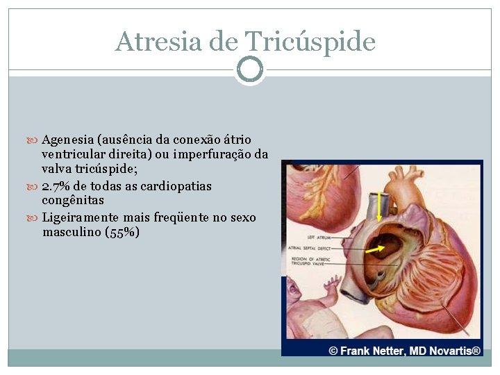 Atresia de Tricúspide Agenesia (ausência da conexão átrio ventricular direita) ou imperfuração da valva