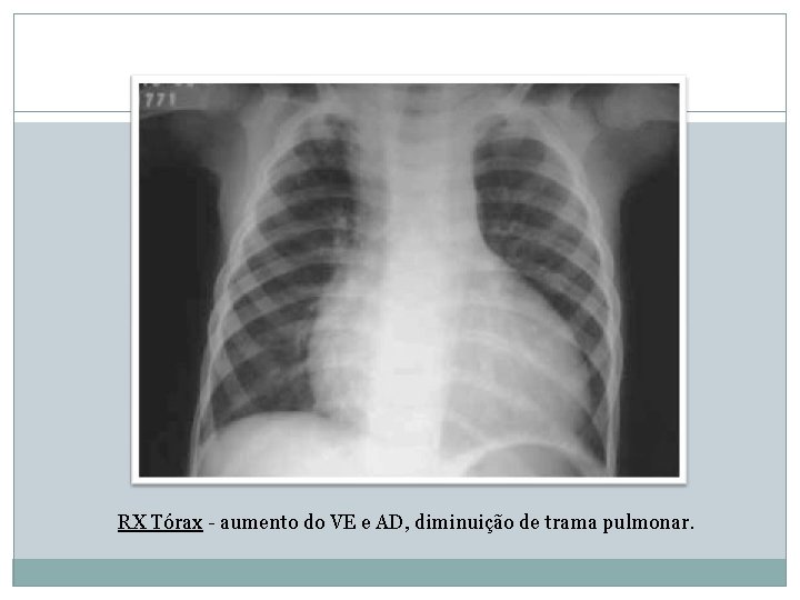 37 RX Tórax - aumento do VE e AD, diminuição de trama pulmonar. 