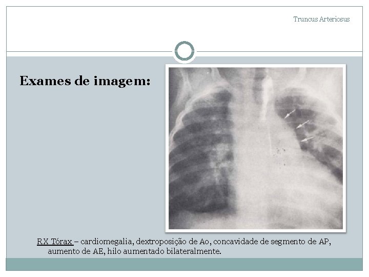Truncus Arteriosus Exames de imagem: RX Tórax – cardiomegalia, dextroposição de Ao, concavidade de