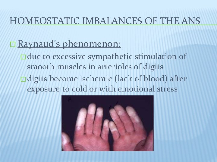 HOMEOSTATIC IMBALANCES OF THE ANS � Raynaud’s � due phenomenon: to excessive sympathetic stimulation