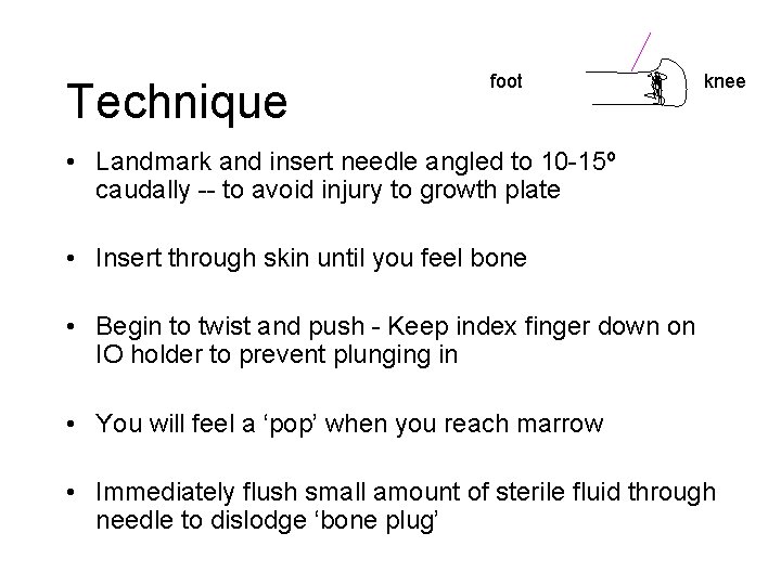 Technique foot knee • Landmark and insert needle angled to 10 -15º caudally --