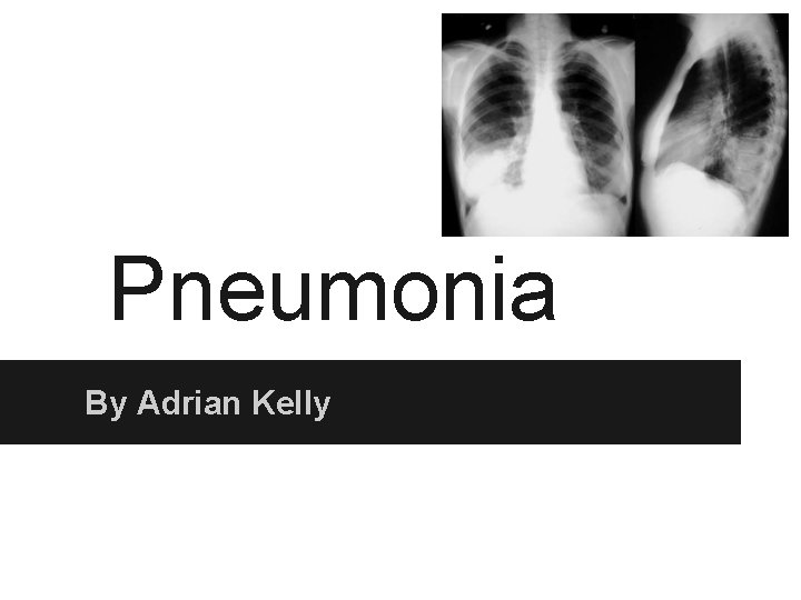 Pneumonia By Adrian Kelly 