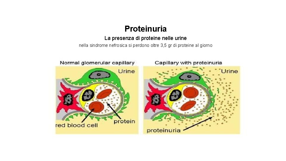 Proteinuria La presenza di proteine nelle urine nella sindrome nefrosica si perdono oltre 3,