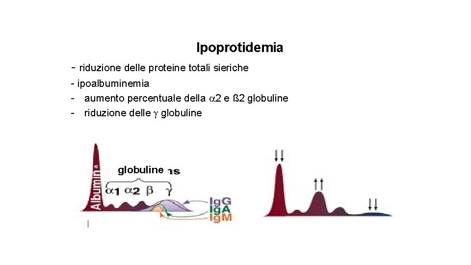 Ipoprotidemia - riduzione delle proteine totali sieriche a - ipoalbuminemia - aumento percentuale della