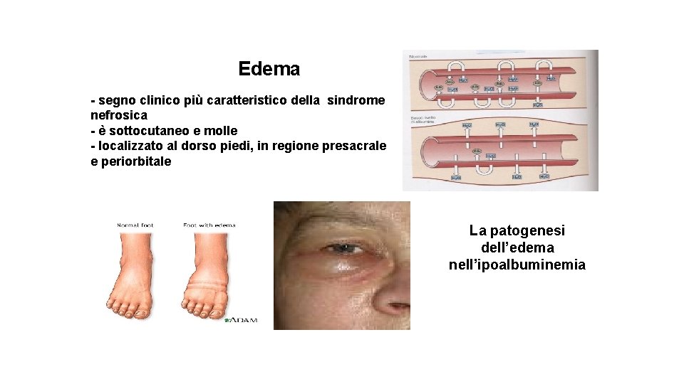 Edema - segno clinico più caratteristico della sindrome nefrosica - è sottocutaneo e molle