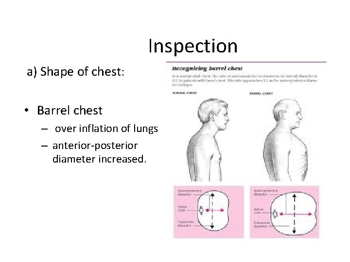 Inspection a) Shape of chest: • Barrel chest – over inflation of lungs –