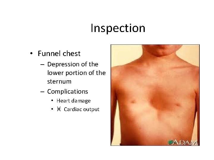 Inspection • Funnel chest – Depression of the lower portion of the sternum –