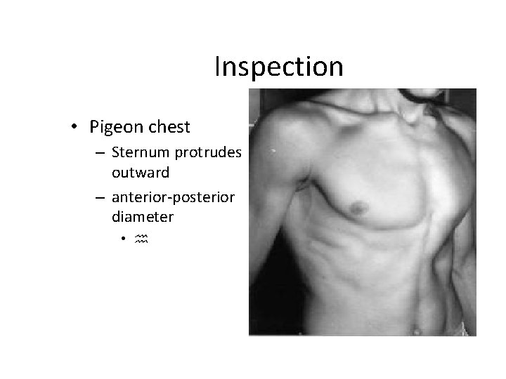 Inspection • Pigeon chest – Sternum protrudes outward – anterior-posterior diameter • h 