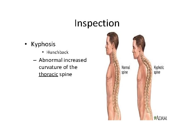 Inspection • Kyphosis • Hunchback – Abnormal increased curvature of the thoracic spine 