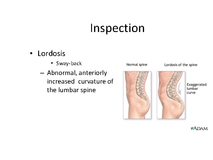 Inspection • Lordosis • Sway-back – Abnormal, anteriorly increased curvature of the lumbar spine