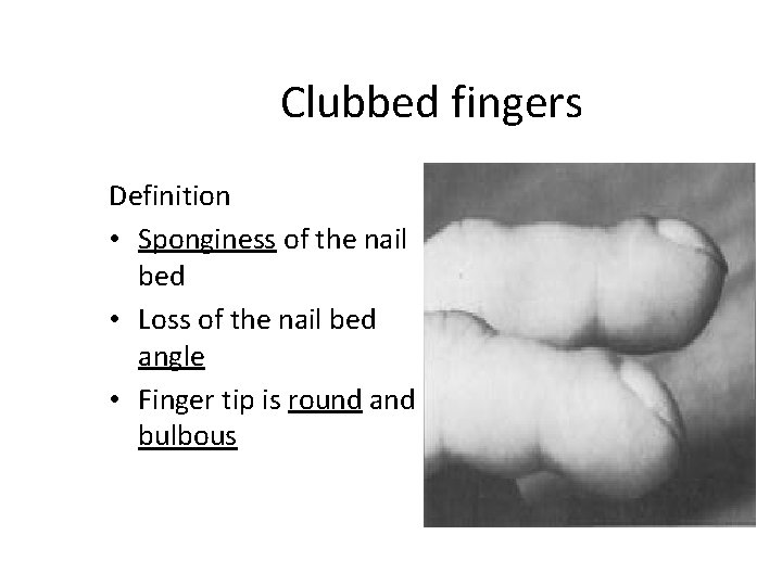 Clubbed fingers Definition • Sponginess of the nail bed • Loss of the nail