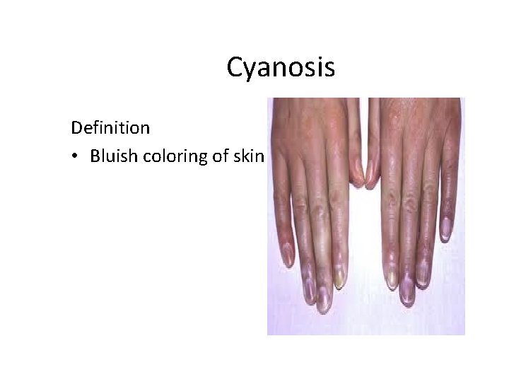 Cyanosis Definition • Bluish coloring of skin 