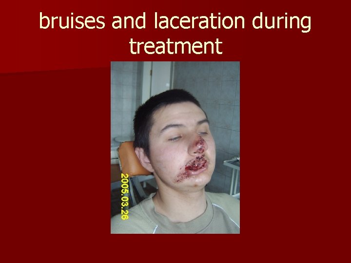 bruises and laceration during treatment 