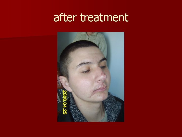 after treatment 