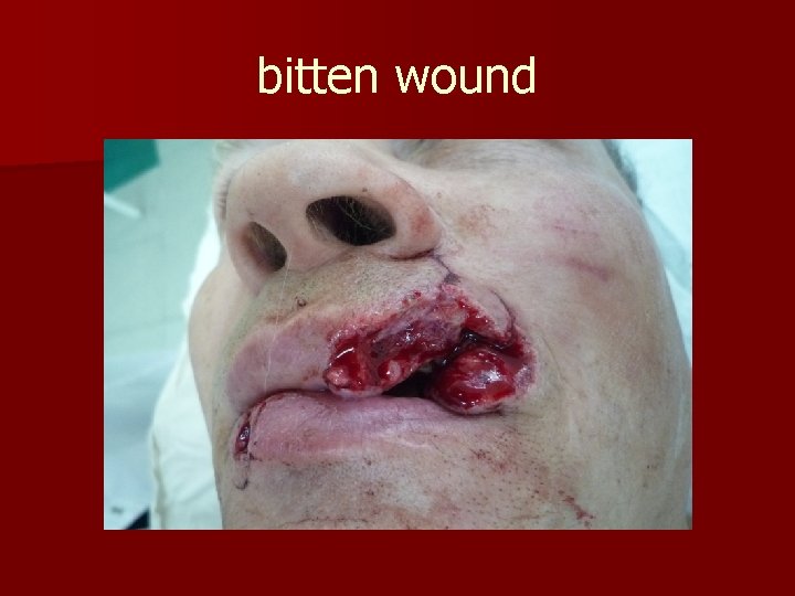 bitten wound 