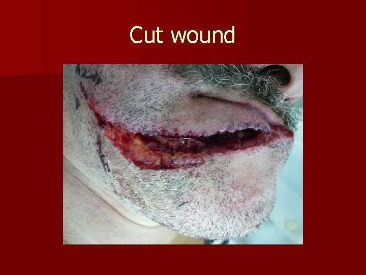Cut wound 