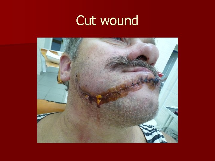 Cut wound 