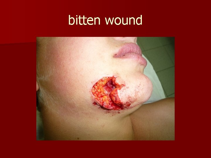 bitten wound 