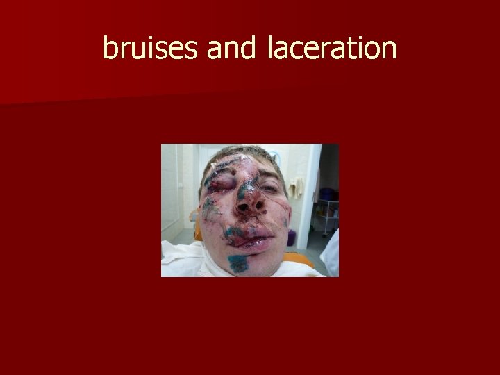 bruises and laceration 