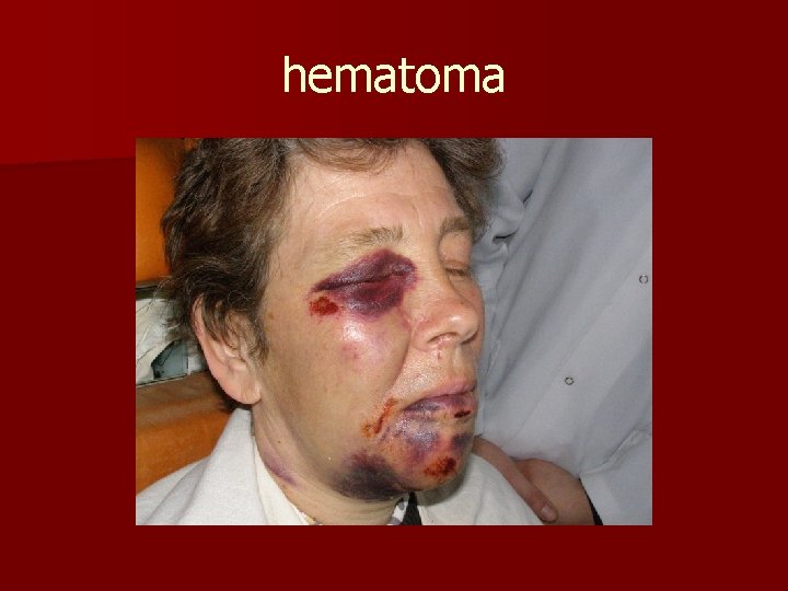 hematoma 