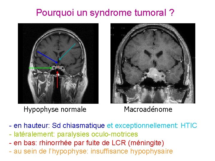 Pourquoi un syndrome tumoral ? Hypophyse normale Macroadénome - en hauteur: Sd chiasmatique et Pourquoi un syndrome tumoral ? Hypophyse normale Macroadénome - en hauteur: Sd chiasmatique et