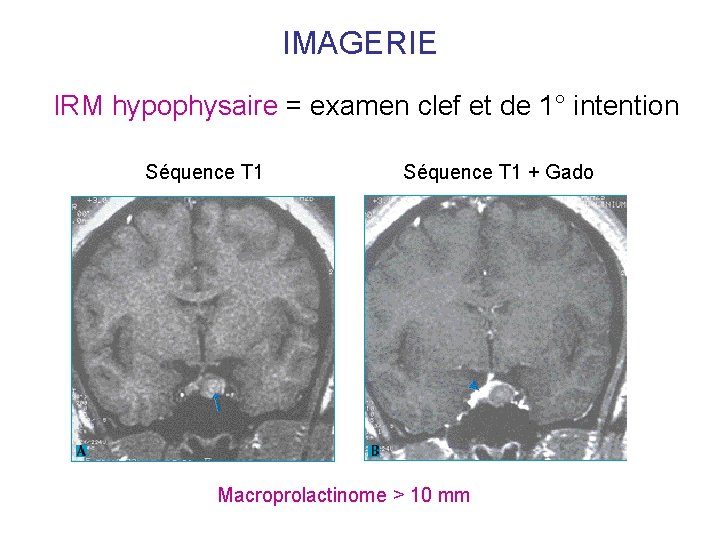 IMAGERIE IRM hypophysaire = examen clef et de 1° intention Séquence T 1 + IMAGERIE IRM hypophysaire = examen clef et de 1° intention Séquence T 1 +