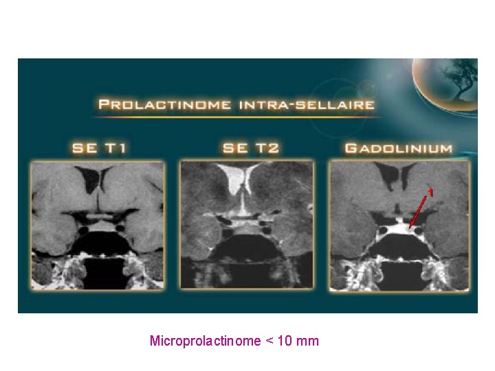 Microprolactinome < 10 mm Microprolactinome < 10 mm