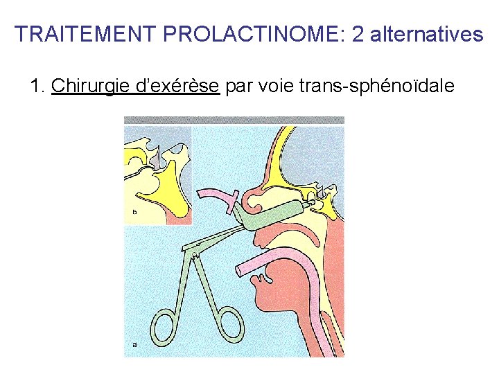 TRAITEMENT PROLACTINOME: 2 alternatives 1. Chirurgie d’exérèse par voie trans-sphénoïdale TRAITEMENT PROLACTINOME: 2 alternatives 1. Chirurgie d’exérèse par voie trans-sphénoïdale