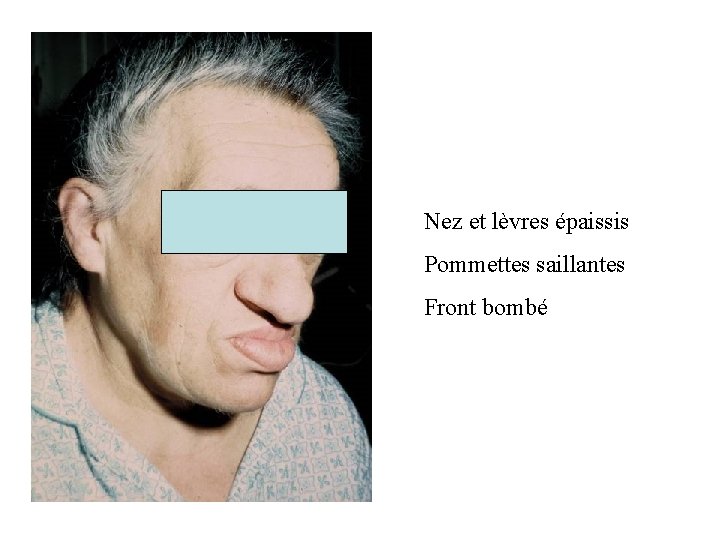 Nez et lèvres épaissis Pommettes saillantes Front bombé Nez et lèvres épaissis Pommettes saillantes Front bombé
