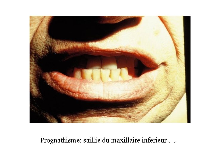 Prognathisme: saillie du maxillaire inférieur … Prognathisme: saillie du maxillaire inférieur …