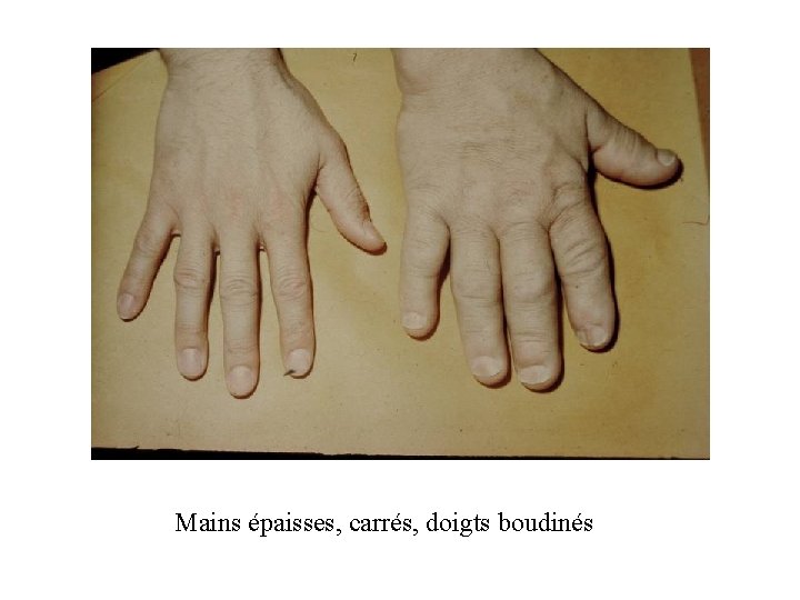 Mains épaisses, carrés, doigts boudinés Mains épaisses, carrés, doigts boudinés