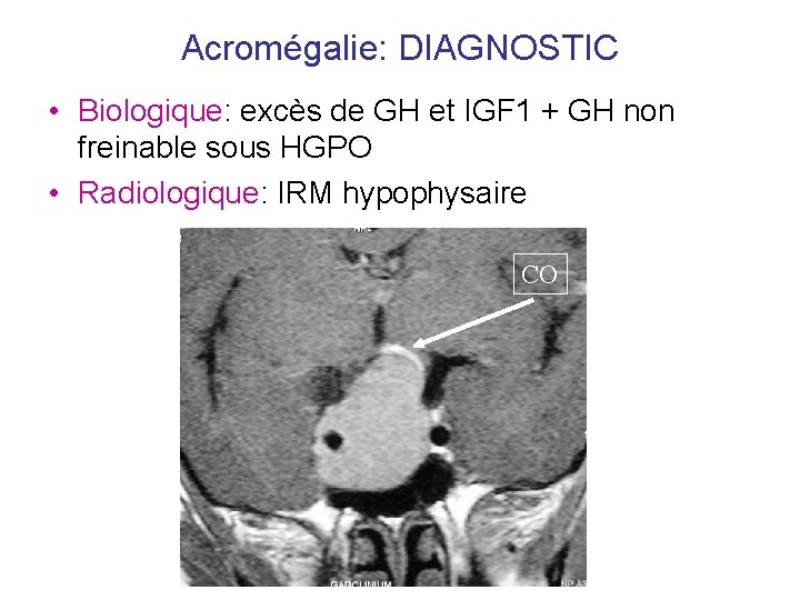 Acromégalie: DIAGNOSTIC • Biologique: excès de GH et IGF 1 + GH non freinable Acromégalie: DIAGNOSTIC • Biologique: excès de GH et IGF 1 + GH non freinable