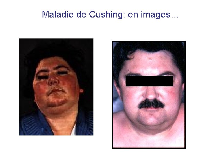 Maladie de Cushing: en images… Maladie de Cushing: en images…