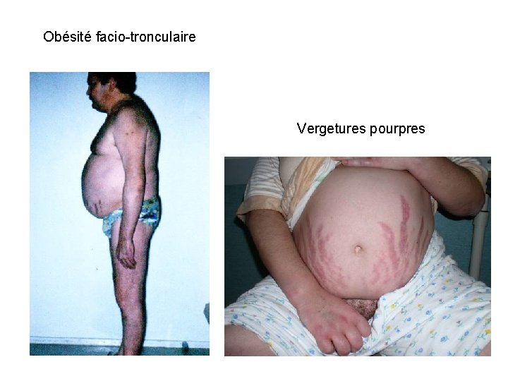 Obésité facio-tronculaire Vergetures pourpres Obésité facio-tronculaire Vergetures pourpres