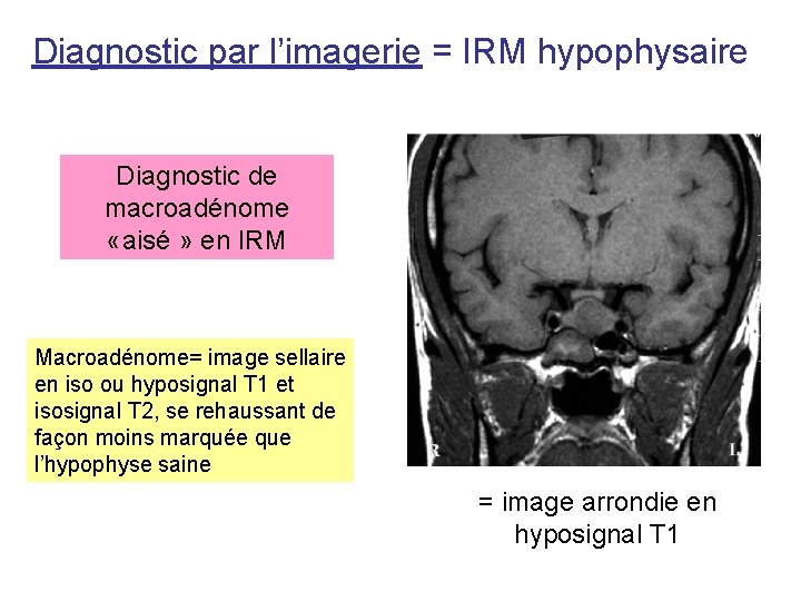 Diagnostic par l’imagerie = IRM hypophysaire Diagnostic de macroadénome «aisé » en IRM Macroadénome= Diagnostic par l’imagerie = IRM hypophysaire Diagnostic de macroadénome «aisé » en IRM Macroadénome=