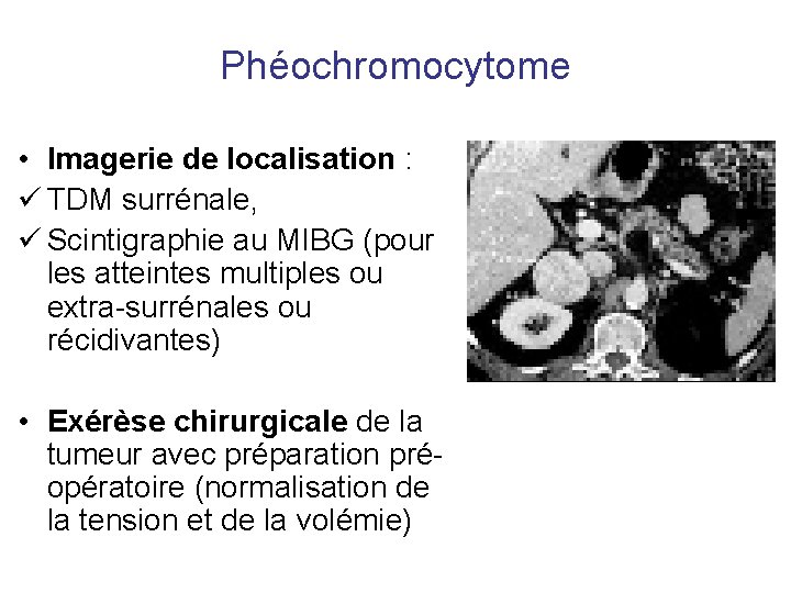 Phéochromocytome • Imagerie de localisation : ü TDM surrénale, ü Scintigraphie au MIBG (pour Phéochromocytome • Imagerie de localisation : ü TDM surrénale, ü Scintigraphie au MIBG (pour