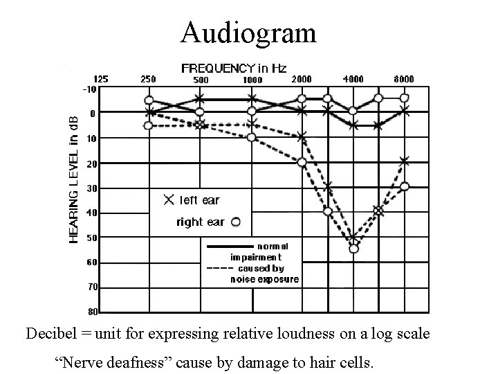 Audiogram Decibel = unit for expressing relative loudness on a log scale “Nerve deafness”
