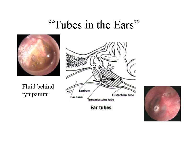 “Tubes in the Ears” Fluid behind tympanum 